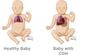 congenital-diaphragmatic-hernia